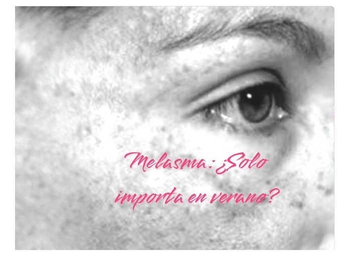 Melasma ¿ Solo importa en verano?